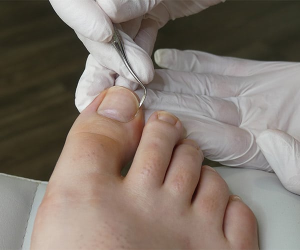 What are the main causes of ingrown toenails? - Beaver Valley Foot Clinic